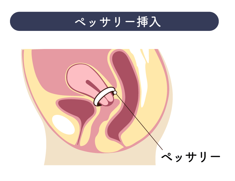 女性泌尿器科専門外来 | 大分泌尿器科病院 | ペッサリー挿入