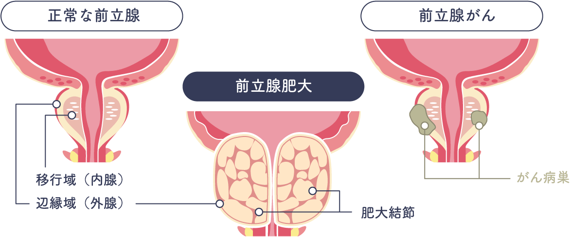 前立腺肥大症 | 大分泌尿器科病院 | 前立腺肥大症とは