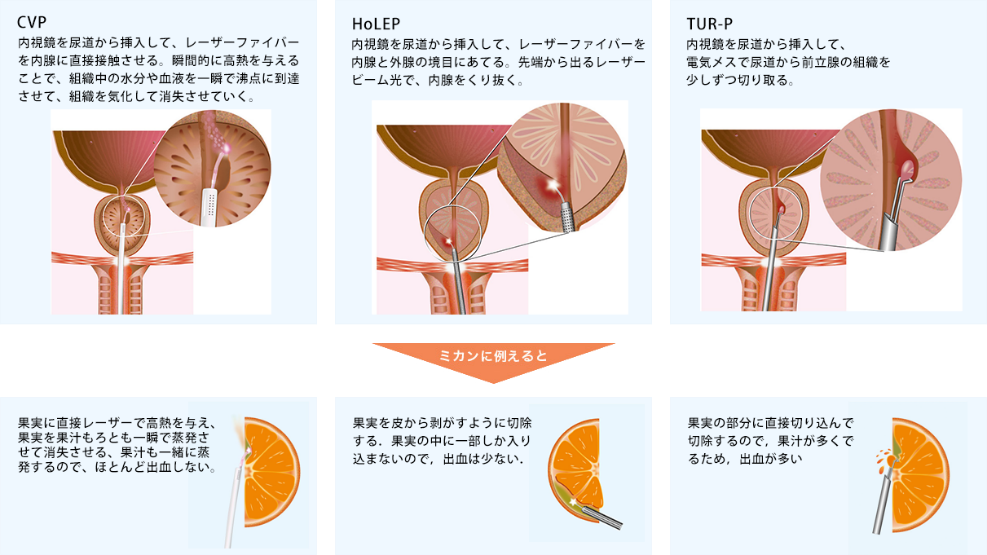 前立腺肥大症 | 大分泌尿器科病院 | 治療について