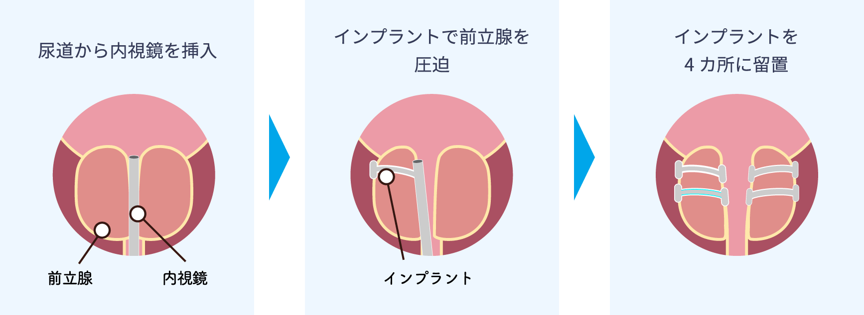 前立腺肥大症 | 大分泌尿器科病院 | 経尿道的前立腺吊り上げ術（Urolift）