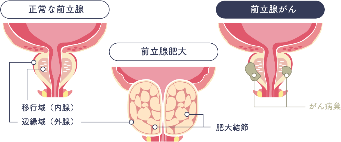 前立腺がん | 大分泌尿器科病院 | 前立腺がん