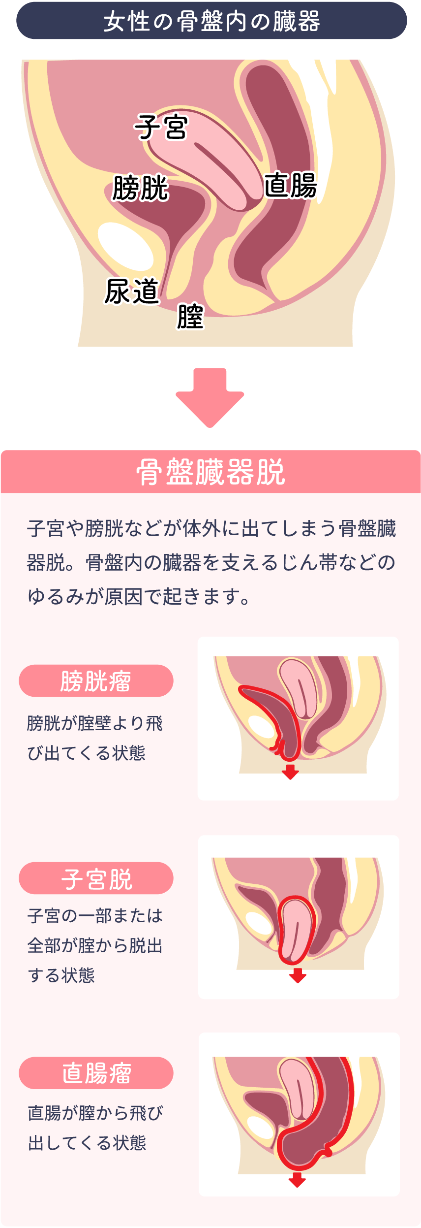 女性泌尿器科専門外来 | 大分泌尿器科病院 | 骨盤臓器脱