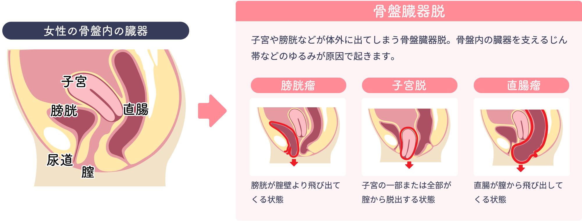 女性泌尿器科専門外来 | 大分泌尿器科病院 | 骨盤臓器脱