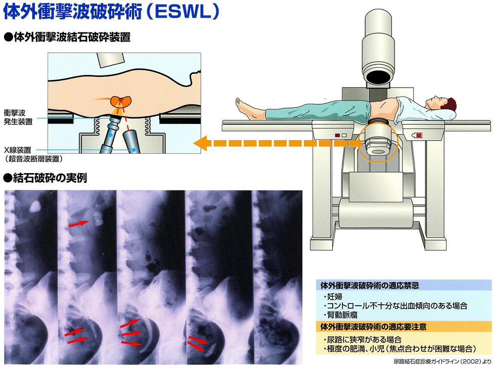 尿路結石 | 大分泌尿器科病院 | 体外衝撃波破砕術（ESWL）