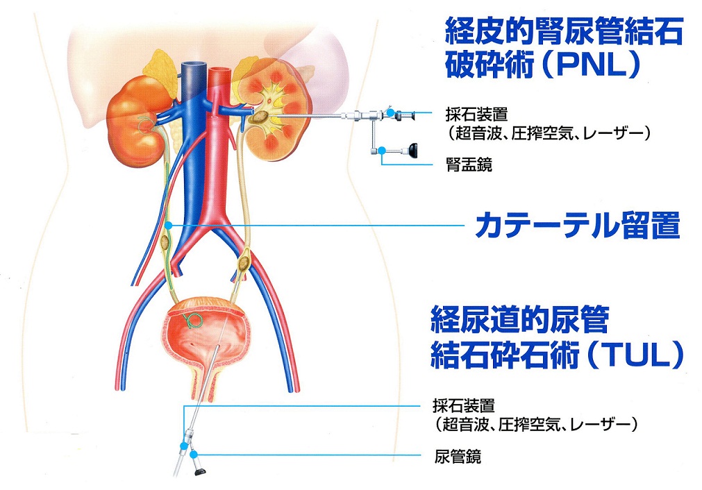 尿路結石 | 大分泌尿器科病院 | 経皮的腎尿管結石破砕術（PNL）