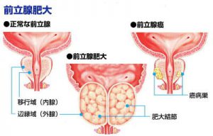 edsタイプ3症候群