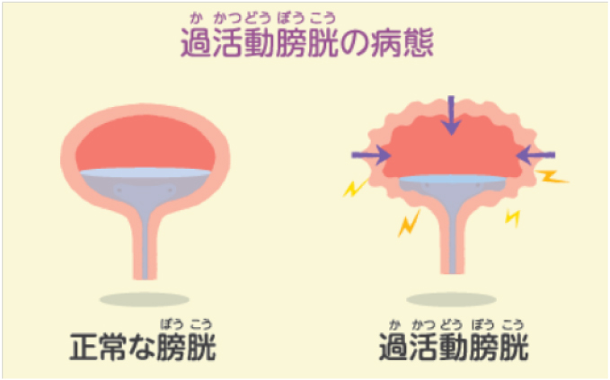 薬 過 活動 膀胱 過活動膀胱の薬で効果が出ない場合でも、治療ができます！