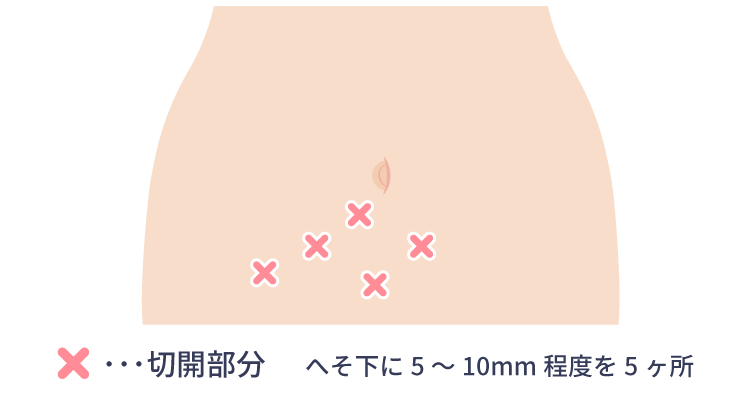 前立腺がん | 大分泌尿器科病院 | 腹腔鏡下前立腺全摘術